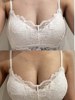 シア(Shia)/バストアップ効果【NFテラピー】