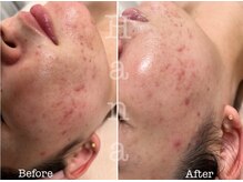 ハナ トータル ケア(Hana Total Care)/ベビースキン水玉リフティング