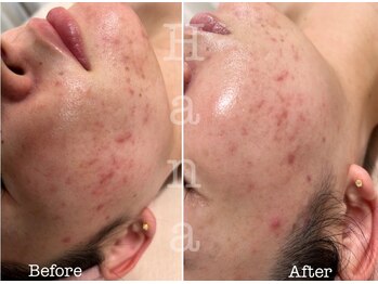 ハナ トータル ケア(Hana Total Care)/ベビースキン水玉リフティング