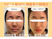 ウル 下北沢(Ulu)/頭蓋骨小顔矯正6回