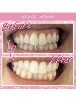 エクシアホワイトニング 長崎店/ホワイトニングビフォーアフター