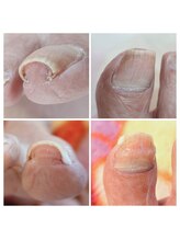 アンティ(Aunty)/個々にあった巻き爪補正