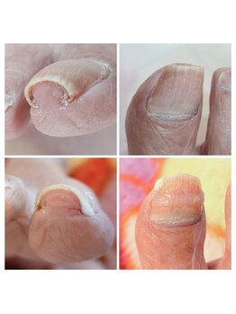 アンティ(Aunty)/個々にあった巻き爪補正