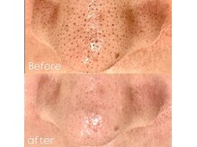 メンズエムボーテ 太田店(Men's M BEAUTE33)の雰囲気(【太田市/メンズ毛穴洗浄】黒ずみ・皮脂汚れを徹底洗浄)