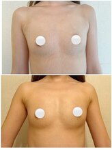 IBC 横浜馬車道店/バストアップBeforeAfter