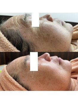 リッツ 所沢店/【Before/After】肌質改善