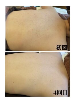 ピリナ 名古屋/【背中ハーブピーリング】症例