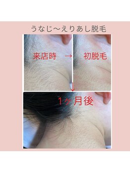 ノノ(nono)/うなじ～えりあし脱毛♪