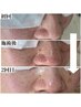 【先着5名様/モニター割】毛穴洗浄による本気の肌質改善したい方90分×2回