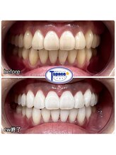 ティースペース(T-space)/クリスタルWhite Plus