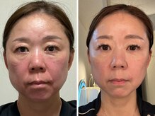 オルゥオルゥ(Olu-.olu.)の雰囲気（私自身改善！どちらもノーファンデです！３ヶ月でのこの結果♪）