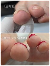 ペルシャ 坂戸駅前店(Persian)/巻き爪ケア♪
