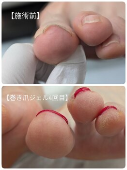 ペルシャ 坂戸駅前店(Persian)/巻き爪ケア♪