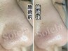 【2回目以降】毛穴の黒ずみ・開き改善フェイシャル】