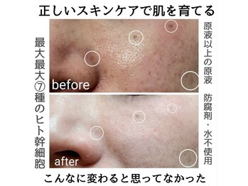 ルオント(LUONTO)/スキンケア症例