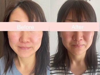 サクラ 伊勢原店(SAKURA)/たるみケアフェイシャルエステ