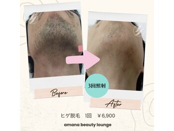 アマナ(AMANA)/【メンズ】ヒゲ脱毛1番人気!