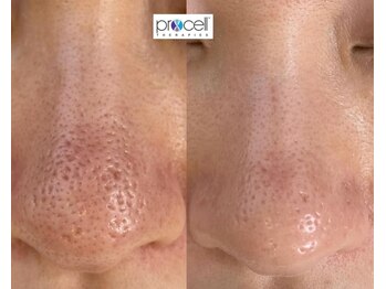 ワンブルーム(OneBloom)/深い毛穴の開きも改善できます!