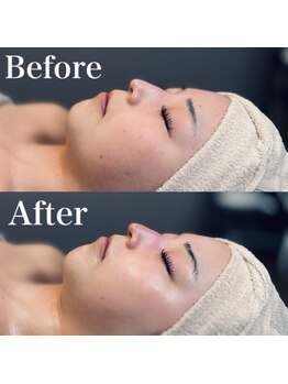 エクリア(ECLIA)/フェイシャル Before⇒After