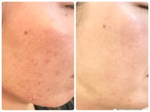 ラウン 京都(ROUN')/約１年の施術ビフォーアフター