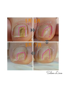 サロン リノ(salon Lino)/トラブルネイル解決しませんか