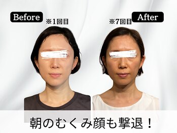 ハリユナイテッド 原宿鍼灸 整体院(HALI UNITED)/朝のむくみ顔も撃退!