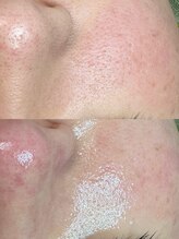 グリーン(green)/思春期毛穴もお任せ♪