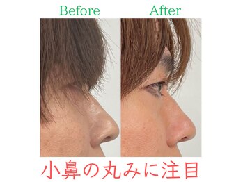 ラプリ 広島八丁堀店(Raplit)/隆鼻+輪郭・小顔矯正 美鼻/小顔