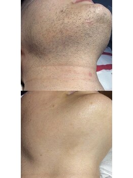 ヴィテラス バイ アリア(Veteras by aria)/☆メンズ・ヒゲ脱毛☆