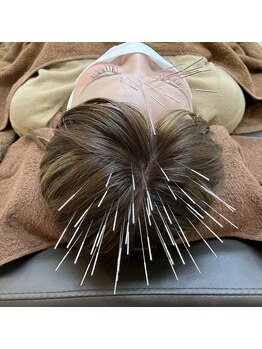 はり処せと/つらい頭痛に