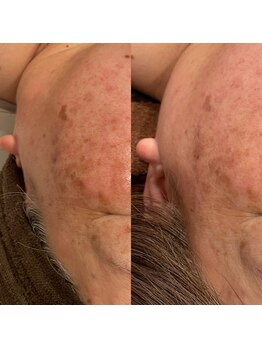 ギャラクシービューティー(galaxy beauty)/光フェイシャル