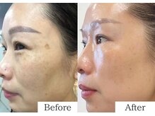 ミューズファクトリー(Muse factory)/濃いシミもケア！あきらめないで