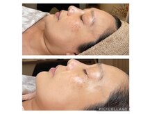 はぐくむ(Hagukumu)の雰囲気（ハリ、弾力90分クーポンのビフォーアフターです。）