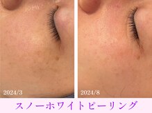 オーシャンブルー 大分店(OCEAN BLUE)/スノーホワイトピーリング