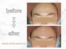 エステプリヴェモロッコ(ESTHE PRIVE MOROCCO)/クリスティーナハーブピーリング