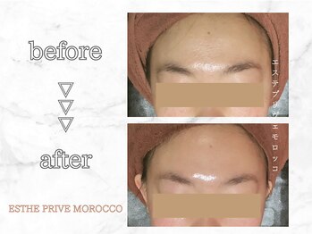 エステプリヴェモロッコ(ESTHE PRIVE MOROCCO)/クリスティーナハーブピーリング