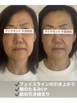 ヴィーナス(Venus)/ダイヤモンドピール/ピーリング