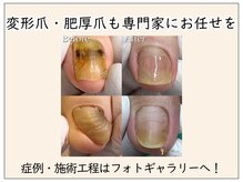 巻き爪補正店 大分店の雰囲気（痛みのある巻き爪を改善！症例についてはフォトギャラリーへ♪）