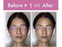 ビジュー(bijoux)/ララピールビフォアフ１回