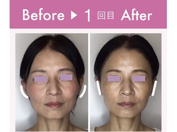 ビジュー(bijoux)/ララピールビフォアフ１回