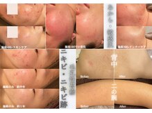 ビジュープラス 水戸店(Bijou+)の雰囲気（ニキビケア満足度◎！！これまでの自分から卒業する根本改善！）