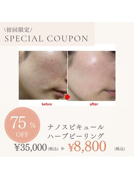 ブプラ 相模大野店(BUPURA)の写真/天然由来ナノスピで肌質改善!ハーブピーリングで憧れのたまご肌へ♪