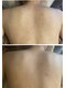 トレ(thore.)の写真/【花嫁様必見】繰り返す背中ニキビにお悩みの方へ…ドレス映えする美背中にもハーブピーリングがおすすめ