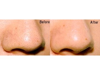 プライベートサロン 美月/毛穴ケア