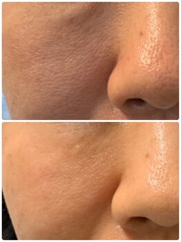 プリュネル(Prunelle)/プラズマシャワー