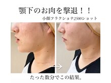 オルネ(ORNE.)/【即効小顔】小顔フラクショナル