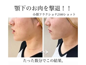 オルネ(ORNE.)/《小顔フラクショナル》