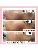 サロンシャイン(Salon Shine)/ハーブピーリング継続