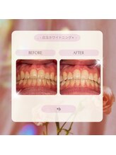 プラスビーセルフ(+b self)/ホワイトニングビフォーアフター