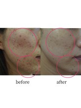 アップルミント/＜フェイシャル＞before・after